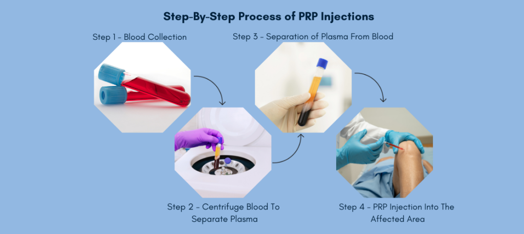 PRP Injection