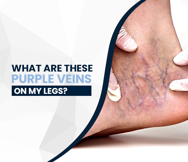 What Are These Purple Veins on My Legs?