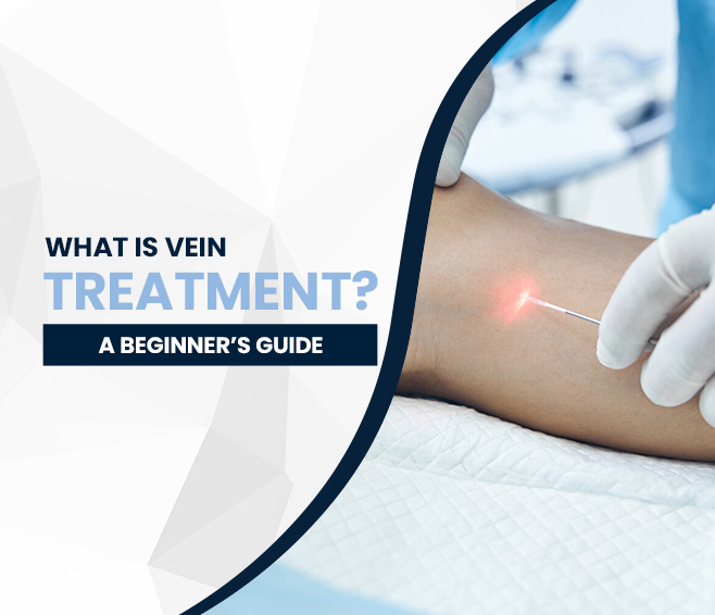What Is Vein Treatment? A Beginner’s Guide